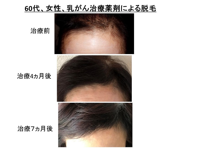 円形脱毛症　病院